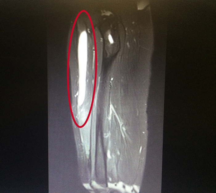 MRI (side view) of an injured quadriceps. The site of injury shows up bright white on the left of the scan.