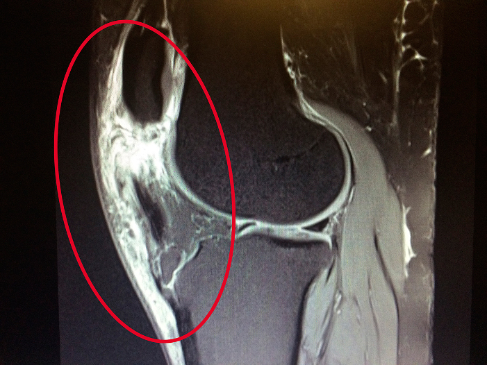 MRI (side view) of an injured patellar tendon, which holds the kneecap in place.