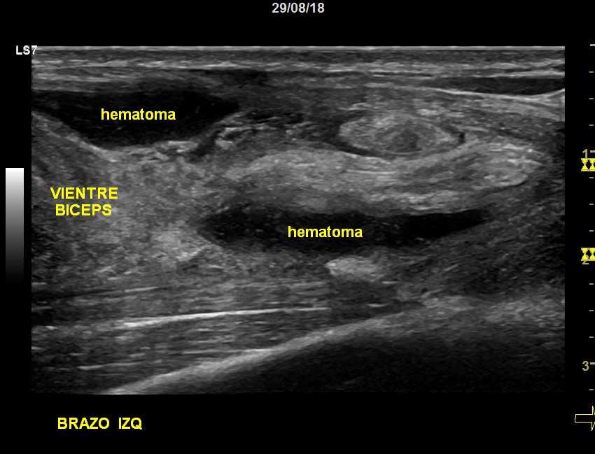 299. Anisotropía Tendón del Bíceps. – Ecografía Fácil
