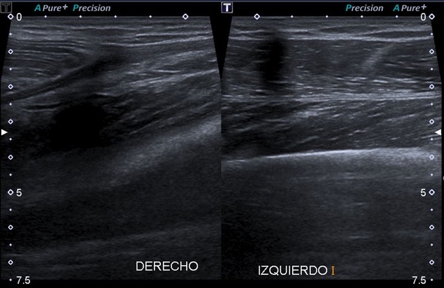 Rotura del recto femoral derecho.