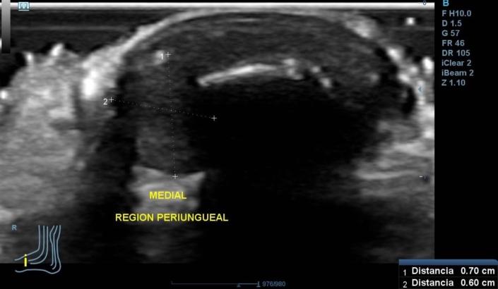 Tumor glómico en el 1º dedo del pie