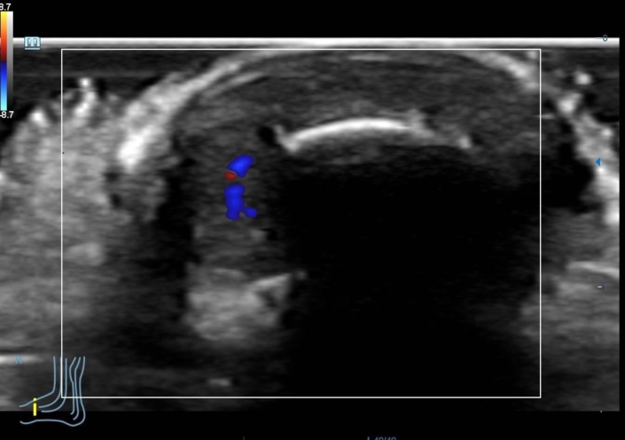 Tumor glómico en el 1º dedo del pie