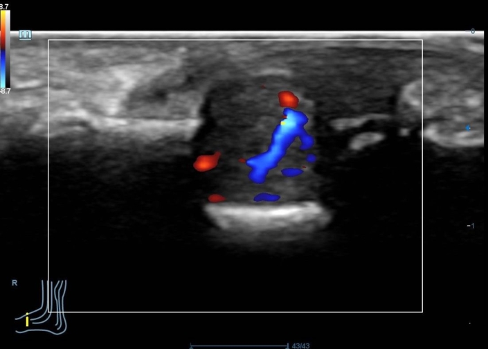 Tumor glómico en el 1º dedo del pie