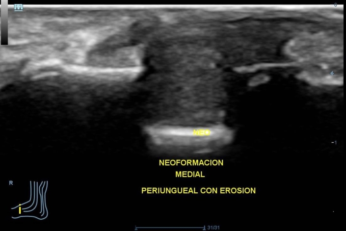 Tumor glómico en el 1º dedo del pie