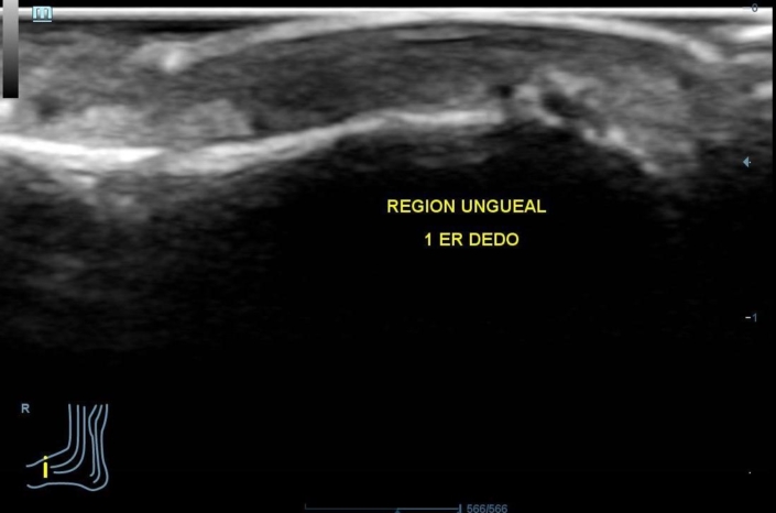 Tumor glómico en el 1º dedo del pie